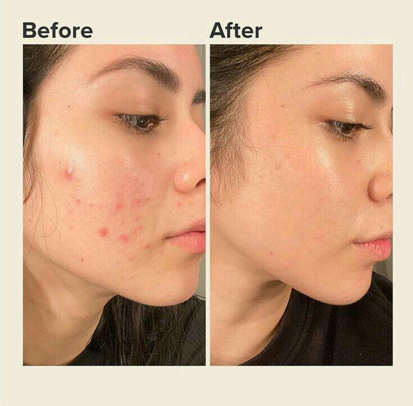 Derma Stamp 140A Micro Needling Tool For Hair, Skin And Acne