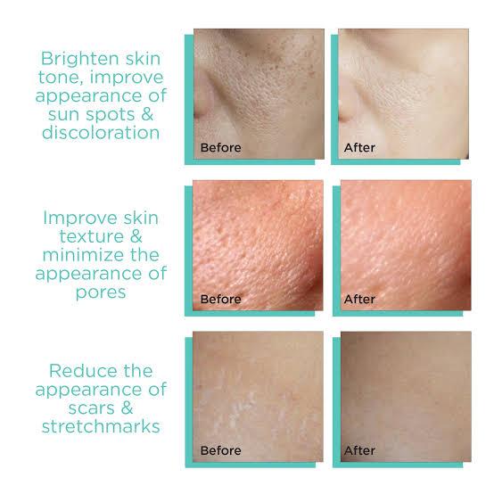 Derma Stamp 140A Micro Needling Tool For Hair, Skin And Acne