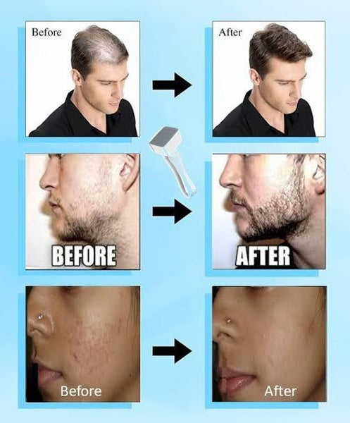 Derma Stamp 140A Micro Needling Tool For Hair, Skin And Acne